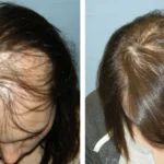 Why Hair Fall Is Increasing in Pakistan and How Envoquee Helps