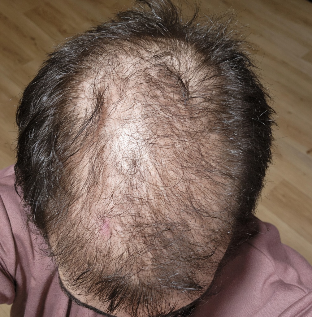 Baldness-Derma